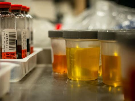 clinical laboratory urine analyzer troubleshooting|clinical laboratory urine testing.